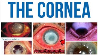 Cornea 6 Major TopicAcanthamoeba Keratitis [upl. by Htebaile588]