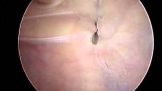 Arthroscopic Lateral Release and VMO Plication  ORV  Stanley Tao MD [upl. by Ahsienel]