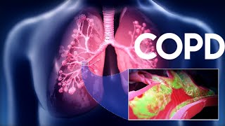 Chronic Obstructive Pulmonary Disease COPDUnit5Pulmonary NursingAHNII Bsn 4rth [upl. by Alberto172]