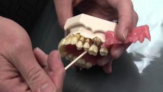 What is Periodontal Disease [upl. by Malinin388]