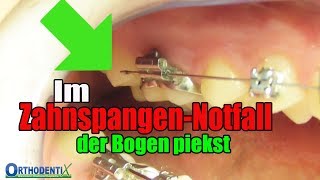 Im ZahnspangenNotfall der Bogen piekst feste Zahnspange Kieferorthopäde  Orthodentix [upl. by Lalaj531]