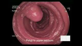 Jejunal polyp [upl. by Lahcsap895]