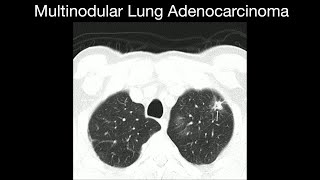 Multinodular Lung Adenocarcinoma [upl. by Lamrej]