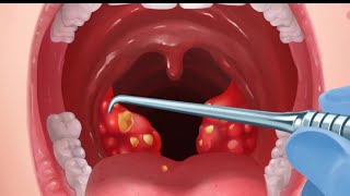 This is how tonsil stones are removed and tooth implant [upl. by Obla196]