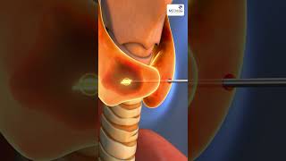 Thyroid Ablation Explained [upl. by Leuqim]