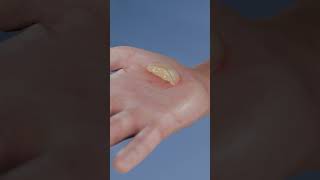 Popping Blisters Should You Ever Do It [upl. by Branden]