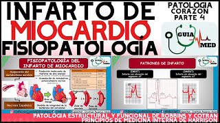 INFARTO AGUDO AL MIOCARDIO FISIOPATOLOGÍA  GuiaMed [upl. by Beverlie]