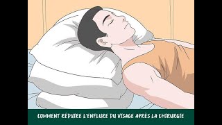 Comment réduire lenflure du visage après la chirurgie [upl. by Joyan]