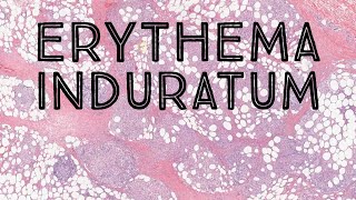 Erythema InduratumNodular Vasculitis panniculitis dermatology dermpath pathology dermatopathology [upl. by Etnaed44]