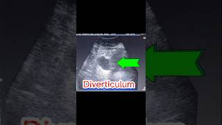 DIVERTICULA BLADDER  U bladder Stone  Cystitis  Residual Urine PMRV ultrasound [upl. by Jeralee723]