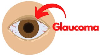 What is GLAUCOMA Symptoms Causes Treatment Prevention [upl. by Danita]