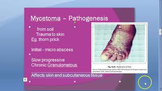 Microbiology 578 a Mycetoma foot Madurella mycetomatis Maduramycosis mycosis Eumycetoma Welsh regime [upl. by Buehrer364]