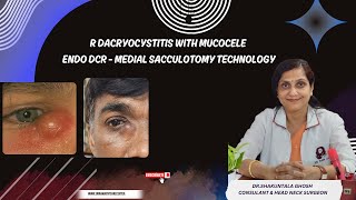 R DACRYOCYSTITIS WITH MUCOCELEENDO DCR  MEDIAL SACCULOTOMY TECHNOLOGY DRSHAKUNTALA GHOSH [upl. by Ademordna]