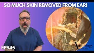 SO MUCH SKIN REMOVED FROM PATIENTS EAR CANAL  EP945 [upl. by Maurilla]