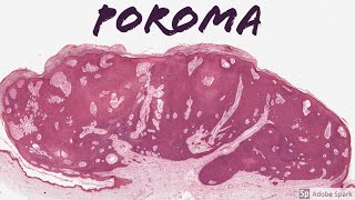 Poroma 5Minute Pathology Pearls [upl. by Ennybor607]