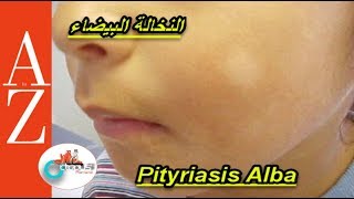 Pityriasis alba  From A to Z  النخالة البيضاء  اسبابها  أعراضها  طرق العلاج والوقاية [upl. by Roon962]