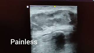 Sebaceous cyst ultrasound and color Doppler video [upl. by Honor73]