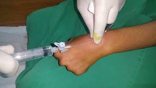 Aspiration of Ganglion of the Wrist [upl. by Rome]