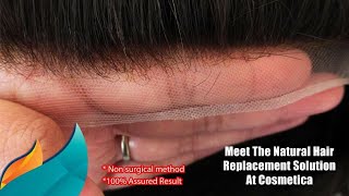 Front Lace Hair System  1st Time in Bangladesh 🇧🇩 [upl. by Tiebout]