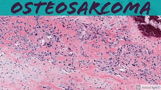 Osteosarcoma 101 Bone Pathology Basics [upl. by Yeltnerb]