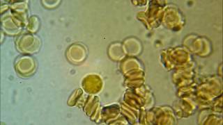 SPIROCHETES  coming out of a WBC [upl. by Grogan332]