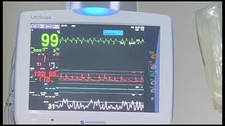 Broad complex tachycardia Sine wave pattern [upl. by Xanthe]