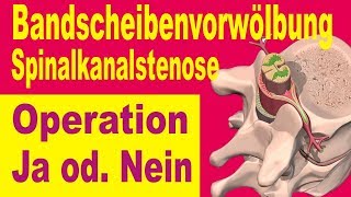 Bandscheibe amp Sianalkanalstenose Operation Ja oder Nein [upl. by Carrillo]