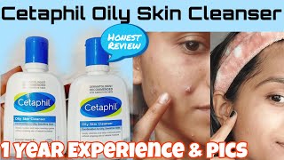 I Tried Cetaphil Oily Skin Cleanser For 1 Year😱Before amp After pics Best Cleanser for Oily Skin [upl. by Fabien]