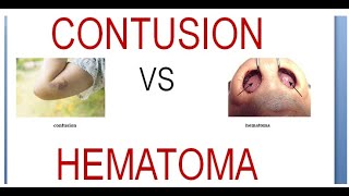 Surgery 011 Wound Contusion Hematoma Difference Vs Compare Between [upl. by Darcia]