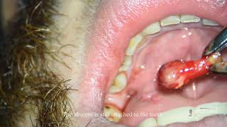 Dental abscess still attached to an infected tooth [upl. by Diarmid]