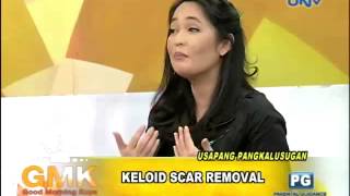 Keloid Scar Removal [upl. by Liz]