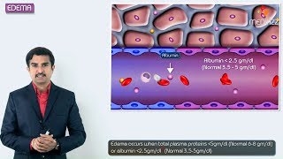 1Edema introduction  Hemodynamic pathology Fmge Neet PG and usmle [upl. by Merrell]