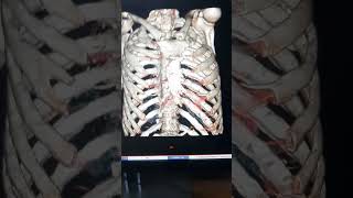 Hrct chest hospital trendingreelsvideo viralvideoshorts daliyvlogneet doctor radiodiagnosis [upl. by Ahsika]