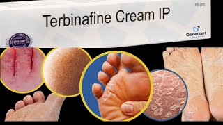 terbinafine hydrochloride creamuseside effecthow to use terbinafine cream nepali [upl. by Paquito]