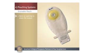 ColostomyIleostomy Pouching Systems [upl. by Eelatan]