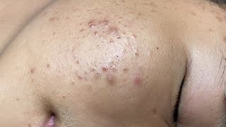 ACNE TREATMENT VU QUYNH MI  Perennial Blackheads On Boy Face 2024FULL [upl. by Elnukeda]