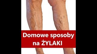 Żylaki  Domowe sposoby na ŻYLAKI [upl. by Goldie]