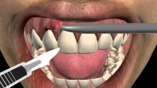 How to treat a tooth abscess [upl. by Nymsaj]