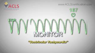 Ventricular Tachycardia by ACLS Certification Institute [upl. by Camille274]