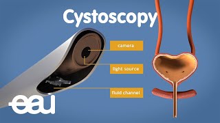 Cystoscopy overactive bladder [upl. by Chaney693]