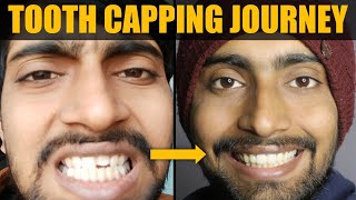 My TOOTH CAPPING Journey Cost Only Rs2000   From Broken Tooth To Get Fixed Properly [upl. by Slaohcin352]