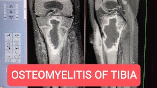 MRI of Tibia with Contrast  Diagnosing Osteomyelitis on GE 15 Tesla [upl. by Eigla]