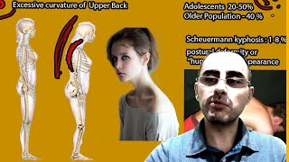 Kyphosis  Symptoms and causes and treatment [upl. by Mya623]