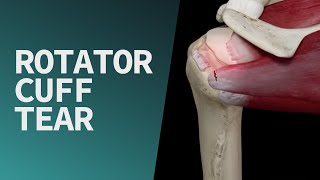 Rotator Cuff Tear [upl. by Gayelord796]