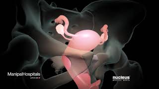 How Is A Robotic Hysterectomy Done  Robotic Hysterectomy Surgery  Gynaecology  Manipal Hospitals [upl. by Nylorak]