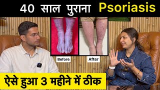 Psoriasis Treatment In Hindi Ft upasanakiduniya  Skin Disease  Himanshu Bhatt [upl. by Kellen]