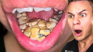 Orthodontist Reacts To Disgusting Teeth Cleanings [upl. by Zanze]