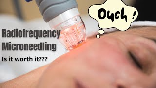 Radiofrequency Microneedling  Does it actually work  Dermatologist reviews [upl. by Dnomed]