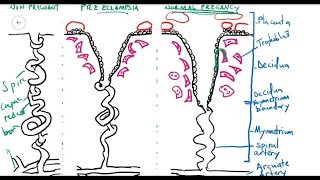 Preeclampsia [upl. by Saraiya]