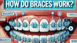 How Do Braces Work [upl. by Elatan170]